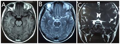 An unexpected case report of epidermoid cyst at the oculomotor nerve: mimicking a common cyst on MRI